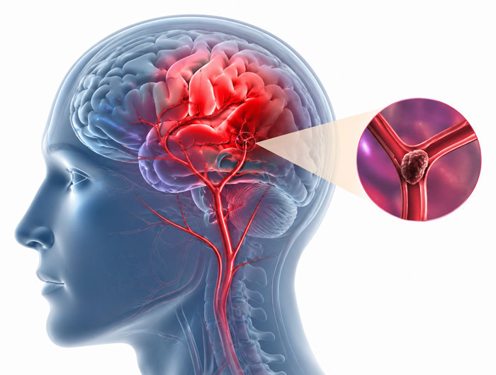 Stroke treatment in Vile Parle, Mumbai