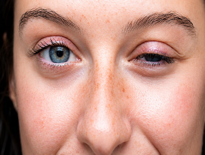 Myasthenia gravis treatment by a neurologist in Vile Parle