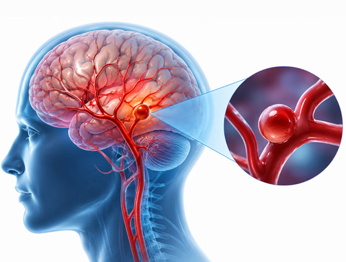 Brain aneurysm specialist in Vile Parle, Mumbai