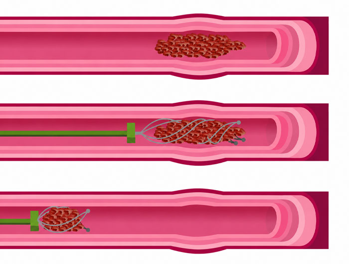 Mechanical thrombectomy for emergency stroke treatment in Vile Parle